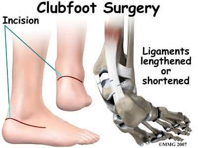 Ccf, talipes equinovarus, talipes, ccf, clubbed foot (en); clubfoot - - Yahoo Image Search Results | Image search ...
