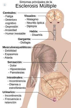 Maybe you would like to learn more about one of these? Esclerosis múltiple: qué es, síntomas, causas, prevención ...