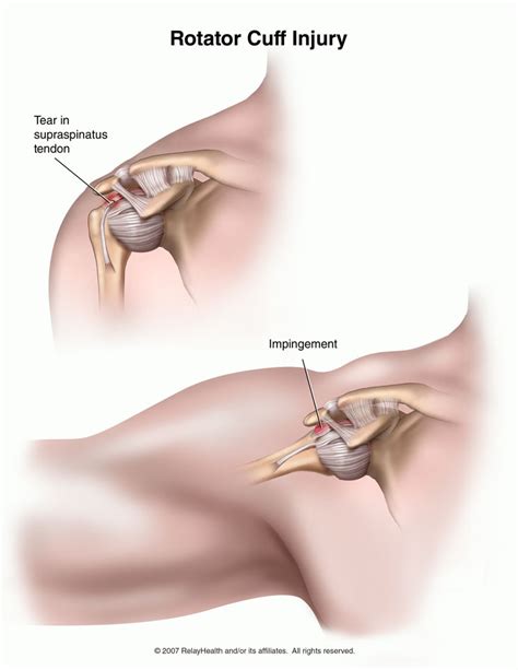 Shoulder problems may limit arm movement, causing pain or discomfort. Strain Or Sprain of Rotator Cuff. Causes, symptoms ...