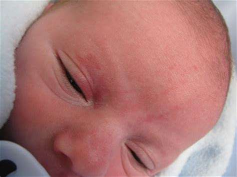 Exposure to cold temperatures frequently causes it. PetitCherie Babies: August 2010