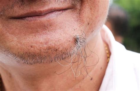 With surgical excision, the doctor numbs the area around the mole and then cuts out the whole mole. Hairy Moles: Why They Appear And If There's Cause For Concern