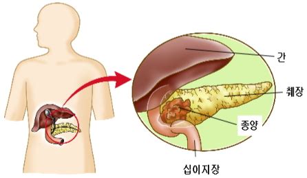 이명(耳鳴, 귀울림)은 외부에서 들리는 소리가 아니라 본인이 신체 내부(귀 안이나 머릿속 등) 소리를 의식적으로 느끼는 증상이다. 트리니티메디컬뉴스