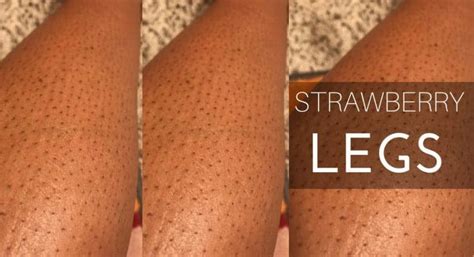 However, it is painful and messy. Dark hair follicles on legs ONETTECHNOLOGIESINDIA.COM