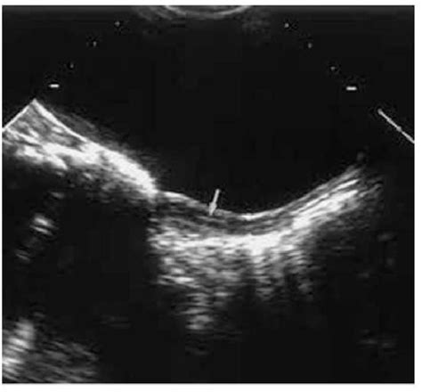 Maybe you would like to learn more about one of these? PDF Ultrasound of the pediatric female pelvis ...