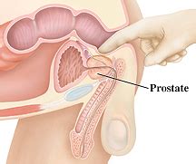 If signs are pointing to prostate cancer, tests will be done. Prostate Cancer Screening - Prostate Conditions and Treatments