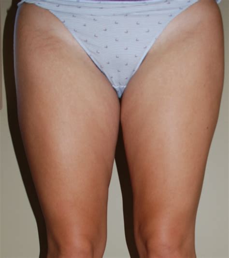 While inner thigh liposuction is a relatively safe procedure then, as with any cosmetic surgery it should not be taken lightly and you should consider other avenues first of all if possible, the most. Liposuction - Harley Plastic Surgery