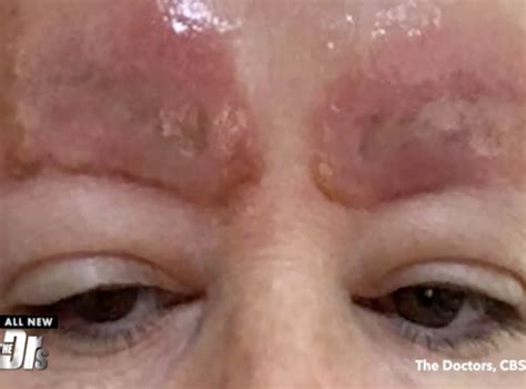 Tattoo artists use ink when they perform their procedures. Microblading warning after semi-permanent tattoo caused woman's eyebrows to swell and scab | The ...