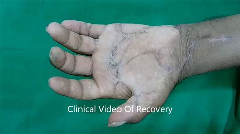 Inability to move hand or finger in appropriate distribution. machine injury with flexor tendon cut - YouTube