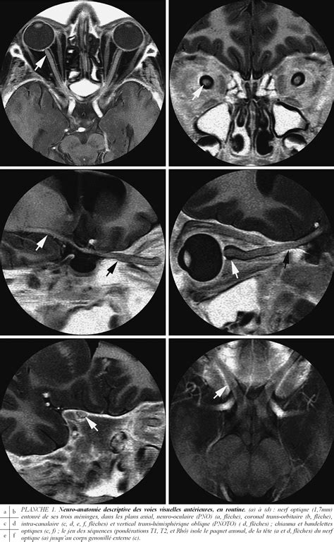 Les voies de la vision, de l’IRM anatomique à la physiologie (IRM(f ...