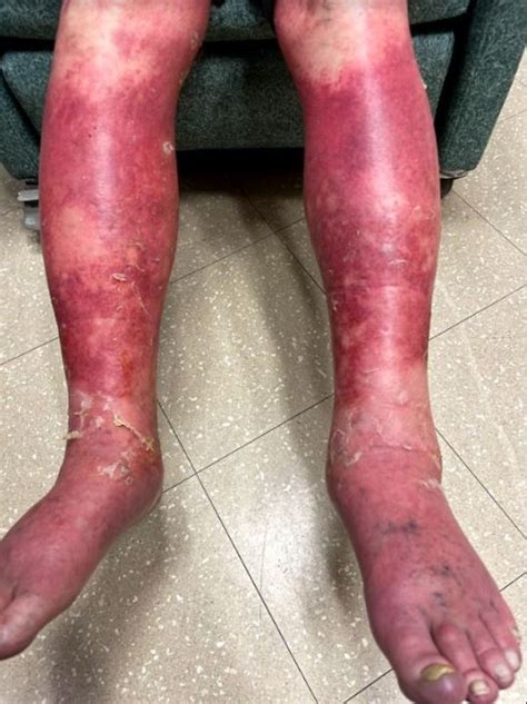 The fda said it was recommending the temporary pause out of an abundance of caution. Man experiences severe skin peeling after taking COVID-19 ...