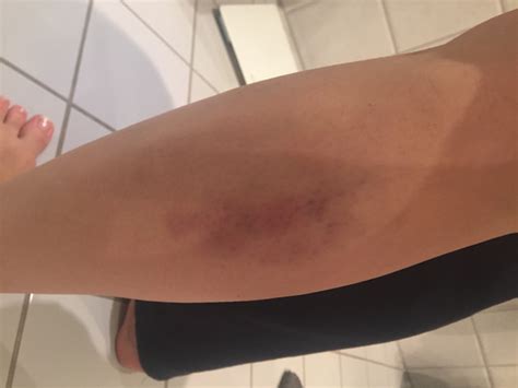 Hier finden sie informationen zu den symptomen entstehung prophylaxe therapie der tiefen beinvenenthrombose (phlebothrombose). Blaue Flecken / Bluterguss durch Kratzen der Wade? (Blauer ...