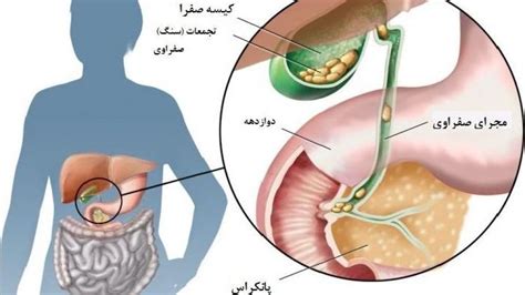 Bile, greenish yellow secretion that is produced in the liver and passed to the gallbladder for concentration, storage, or transport into the first region of the small intestine, the duodenum. آنچه باید درباره سنگ «کیسه صفرا» بدانید