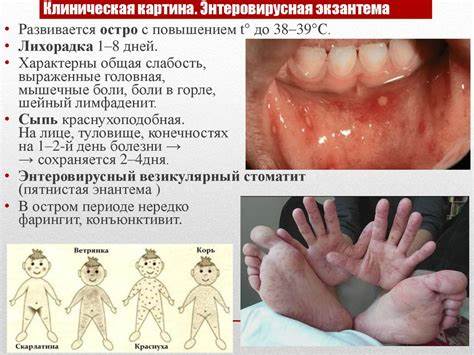 Энтеровирусные инфекции (вирусы Коксаки и ECHO) - презентация онлайн Картинка - Энтеровирусные инфекции (вирусы Коксаки и ECHO) - презентация онлайн