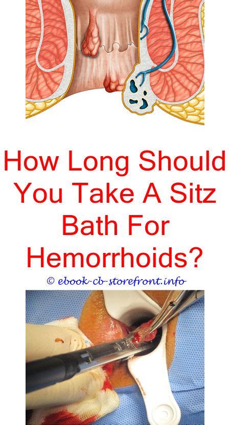 Can hemorrhoids last for weeks? 14+ Marvelous Hemorrhoid Symptoms How To Get Ideas