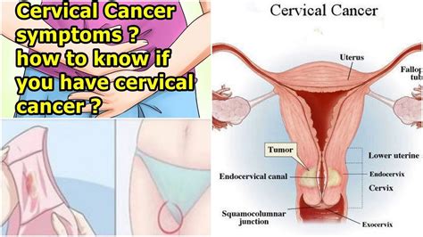 This type is also called endometrial cancer. Uterine cancer early signs Înțelesul "premenopausal" în ...