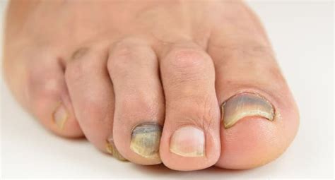 It is this down that is most valued, because it is the structure of the camel's hair is very heterogeneous. Here's why your toenails are black | TheHealthSite.com