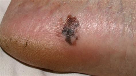 Skin cancer is a general term for three distinct cancers that can appear on the foot: Foot Melanoma: Symptoms, Causes, and Treatments