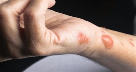 Seek medical care if the wound. How to Get Rid of Burn Scars Naturally - HEALTHY FOOD ADVICE