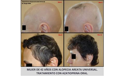 Alopecia universalis (au), also known as alopecia areata universalis, is a medical condition involving the loss of all body hair, including eyebrows, eyelashes, chest hair, armpit hair, and pubic hair. Alopecia Areata - Solución, causas, problema, tratamiento ...