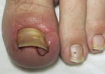 Most commonly, a bacterial or fungal infection, in or around the nail bed. INGROWN NAIL SURGERY - Total Care Podiatry