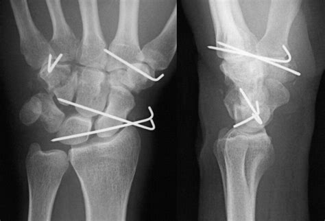 Transhamate Periscaphoid Axial Radial Fracture Dislocation ...