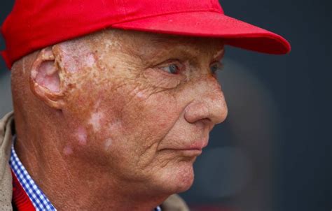 Laudas unfall 1976 auf dem nürburgring hat spätfolgen. Bilderstrecke zu: Interview mit Niki Lauda 40 Jahre nach ...