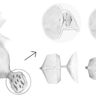 Parameters of left atrial appendage function. LAA morphologies. The four most common LAA morphologies ...