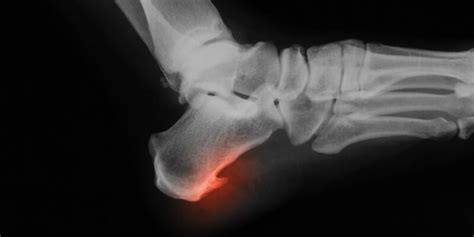 Check spelling or type a new query. Bone Spurs: Symptoms, Types, Treatment & More | The ...