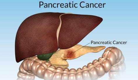 If it is diagnosed at an early stage then an operation to remove the cancer gives some chance of a cure. Pin on سرطان البنكرياس اعراضه واسبابه