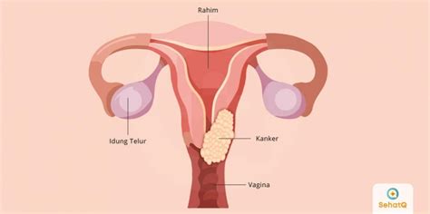 We did not find results for: Kanker Vagina | Tanda dan Gejala, Penyebab, Cara Mengobati ...