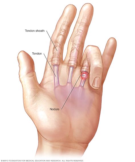 I have had significant cactus spines in my hands and lower legs. 도봉구 봉독 봉침손가락이 잘 펴지지 않아요-방아쇠수지증후군 : 네이버 블로그