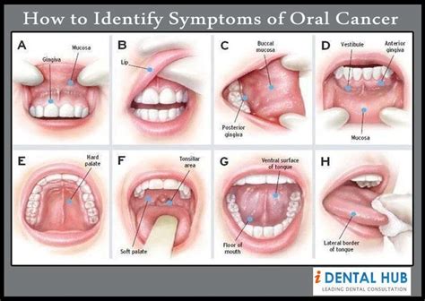If you encounter any of these forms of betel or areca nut, avoid them to reduce your oral cancer risk. Pin by Identalhub on Dental Care @ Identalhub | Pinterest