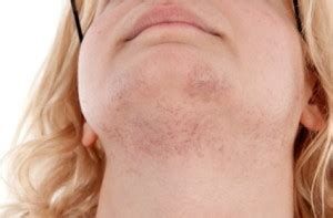 An increase in facial/body hair is called hypertrichosis. What's Causing Your Female Facial Hair? - Health Tips ...