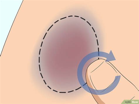 Do this regularly to make a bruise go away faster. Come Eliminare un Livido: 21 Passaggi (Illustrato)