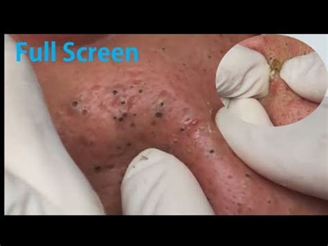 As if it was trapped under my skin. REMOVAL DEEP BLACKHEADS ON CHEEKS - LARGE BLACKHEAD | New ...