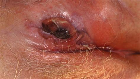 When they do occur, signs of colon cancer in women tend to be the same as those seen in men, and can include: Vulvar Cancer - Causes, Symptoms, Staging, Prevention ...