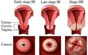 You can find certain types of cancer without a biopsy. Cervical Cancer Treatment - Dr Lisa Wong - Mount Elizabeth ...