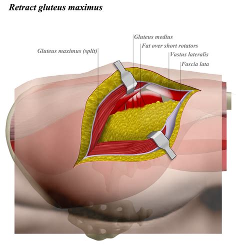 You've got the diaphragm at the top (the posterior parts of the. Posterior Approach to the Hip - Anatomy - Medbullets Step 2/3