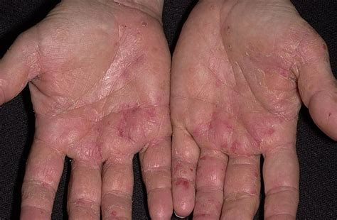 A doctor checked on vasculitis and they think it is that.i seem to think there is a bacterial. Eczema on the Palms Pictures - 224 Photos & Images ...