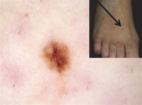 The disease is also known as charcot joint and neuropathic osteoarthropathy. Why Is Melanoma Survival Rate Higher for Stage 0 vs. Stage ...