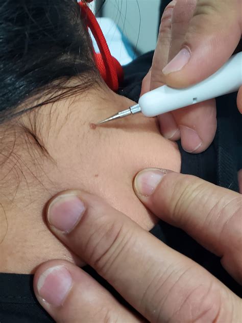 Skin tag removal include surgical excision, cryotherapy, cauterization, and ligation, a suture is tied around the base until the skin tag falls off. Skin Tag Removal Cauterization Equipment - Facial Care