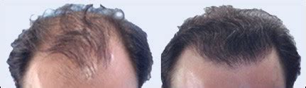 La perte de cheveux touche de nombreuses personnes, elle est source de stress quotidien et peut entraîner un hairmed vous propose la greffe de cheveux à l'étranger de haute qualité pratiquée par des chirurgiens experts en greffe capillaire. Greffe de cheveux et implants capillaires - Dr Abimelec