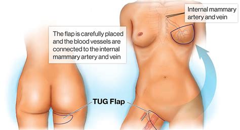 The hip and the knee. Inner Thigh or Transverse Upper Gracillis (TUG) Flap | New ...