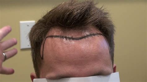 Hair transplant surgery is probably the best treatment for high hairline in teenage males. Receding Hairline Transplant San Francisco Mens Hair ...