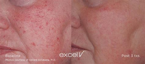 This treatment can help with a variety of concerns including aging skin, acne, and even wound healing and pain. Excel V - Laser Skin Treatment in Des Moines, Iowa