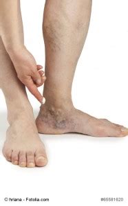 Can you get a blood clot in your knee. DVT Treatment Glen Mills, PA | Vein Center Brinton Lake
