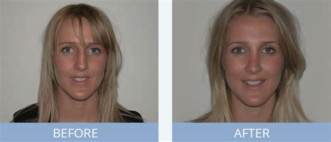 If a good nose job means that nobody notices anything but your overall improved appearance, what while a surgeon can't predict everything about your healing process, it is their job to consider the. Nose Job Surgery & Rhinoplasty in Sydney | Refine Clinic