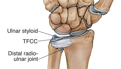 Triangular fibrocartilage complex, abgekürzt tfcc; Triangular fibrocartilage complex injury