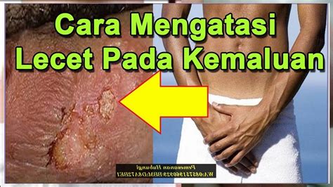 Maybe you would like to learn more about one of these? Cara Mengatasi Lecet Pada Kemaluan - YouTube