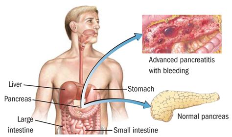 Jenis sista ini bukan kanser. Blog: Medical Articles 2016 - Dr. Indra K. Muhtadi ...